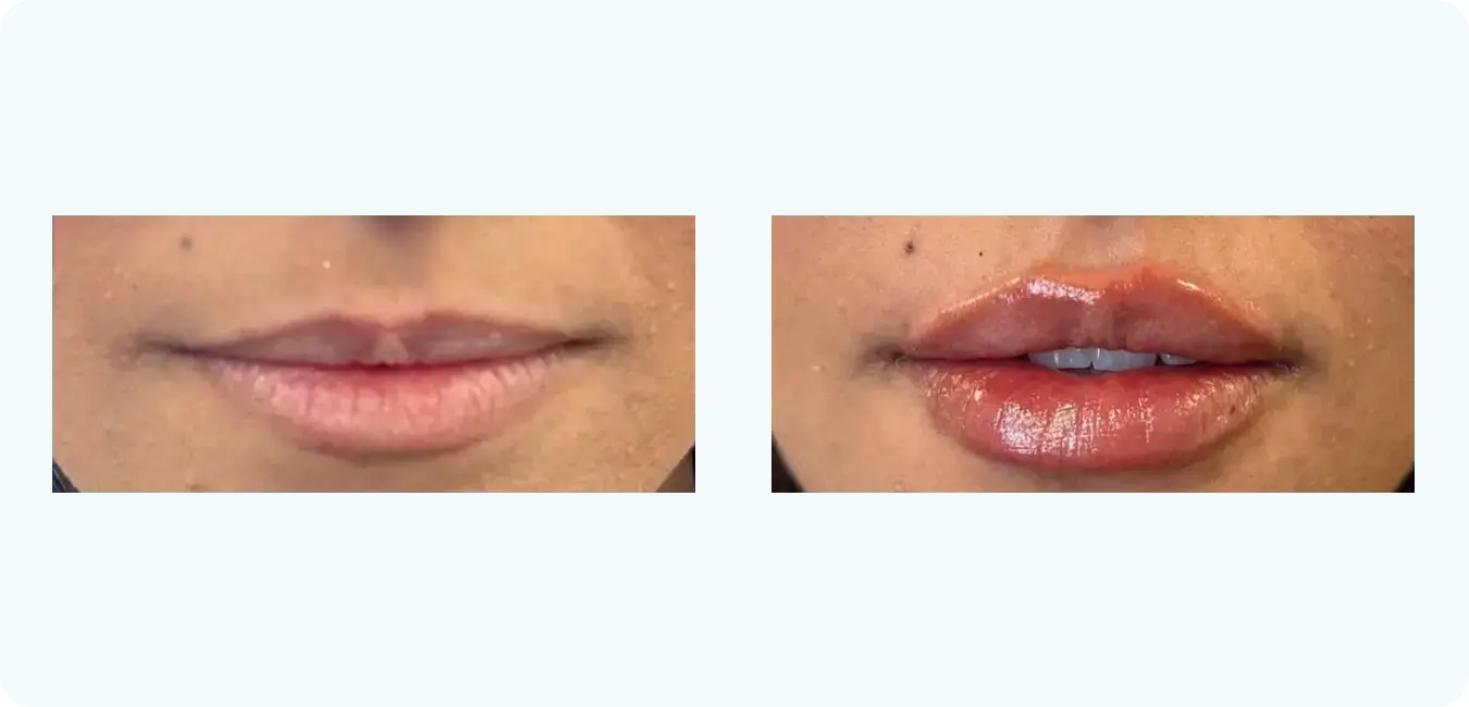 lip-filler lip-filler