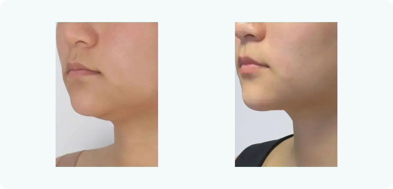remove-double-chin remove-double-chin