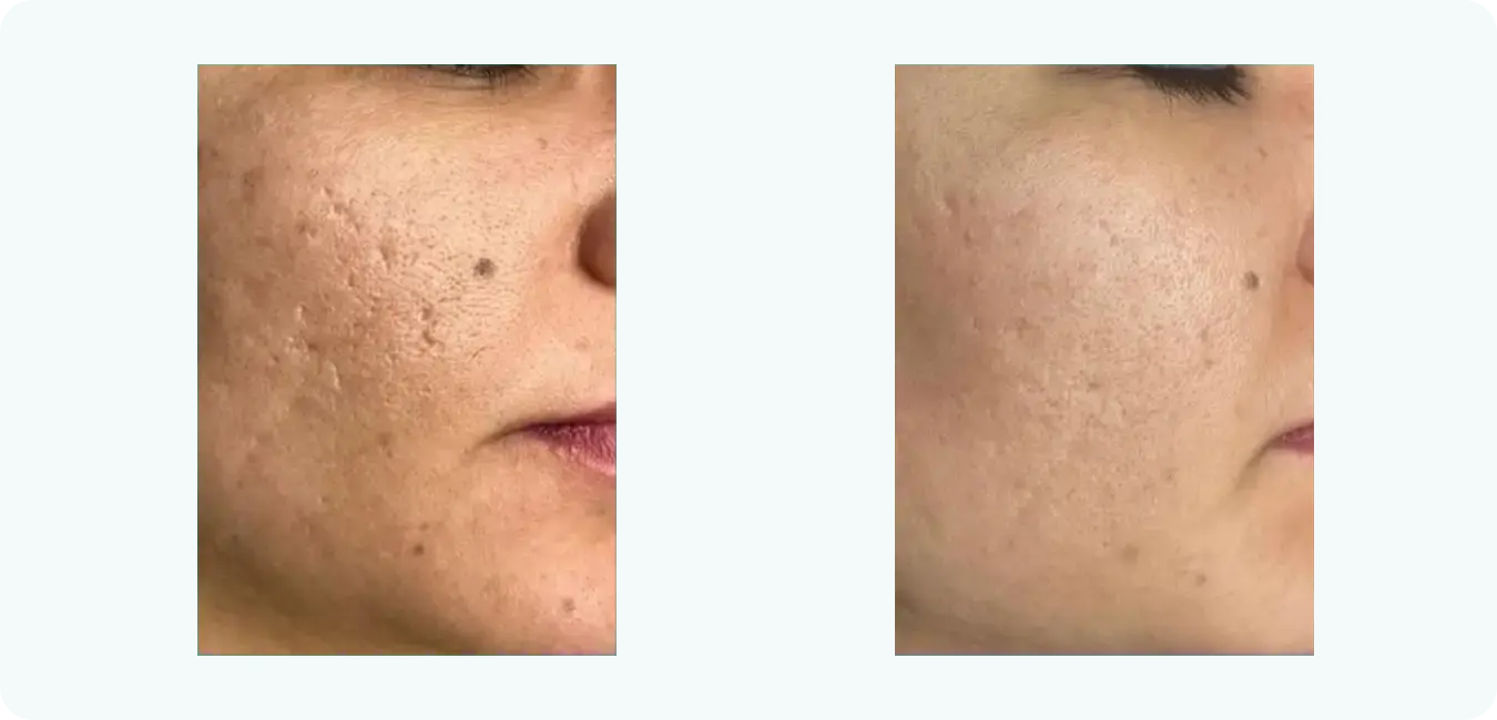 scars-treatment scars-treatment