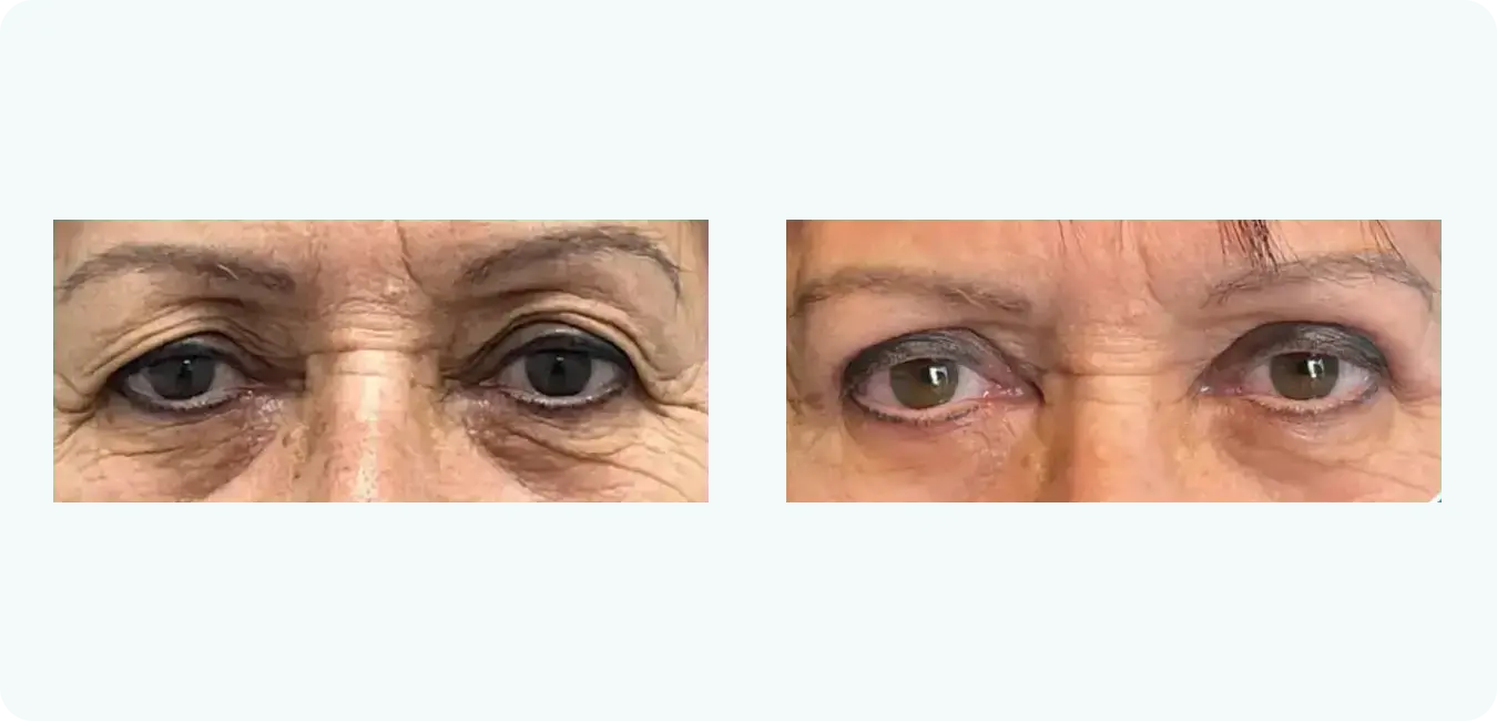 upper-blepharoplasty upper-blepharoplasty
